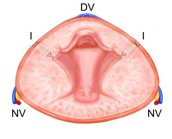 Prostatic Urethral Lift
