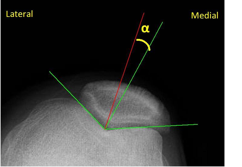 The congruence angle (α) lower than 16 to lateral or medial direction is considered as normal.