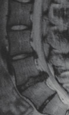 The lumbar disc herniation at / was absorbed, although the posterior endplate lesion still remained at / ((a) and (c)).