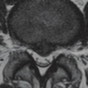 MRI, compared to those taken when she was 18 years old, revealed severe stenosis at /5 and the lesion of the posterior