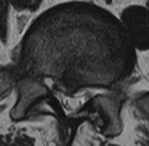 The endplate lesion seemed not able to remodel or not able to become resorbed. The abnormal mechanical stress at the posterior lumbar lesion occurred twice at the age of 14 and 17 in this case.