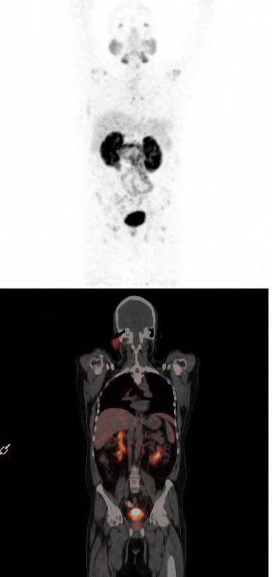 Known case of metastatic cancer of prostate with bony pain, patient