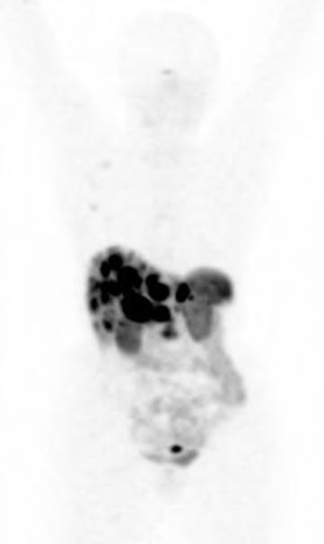 68 Ga-DOTATATE PET/CT in Metastatic NET of Unknown Primary (CUP- NETs) 56 years old female, liver