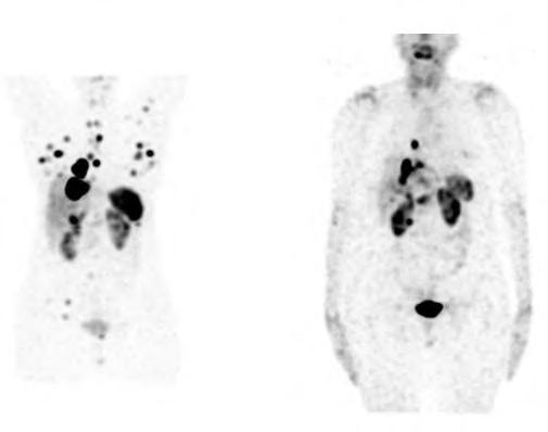 53/F, diagnosed as a case of atypical carcinoid of lung (MiB1 index of 6-10%.), MiB 1 index of 6-10%. Multiple SSTR positive lesions in liver, both lungs, multiple rib & right sided pelvis.