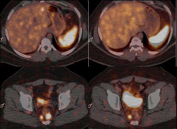 68-Ga DOTATOC scan showed multiple SSTR positive lesions in liver and pre sacral nodes. Seg III, Seg IV B (SUVmax : 39.7), Seg VI and Seg VIII (SUVmax : 26.3). Presacral node at S1 (SUVmax : 45.