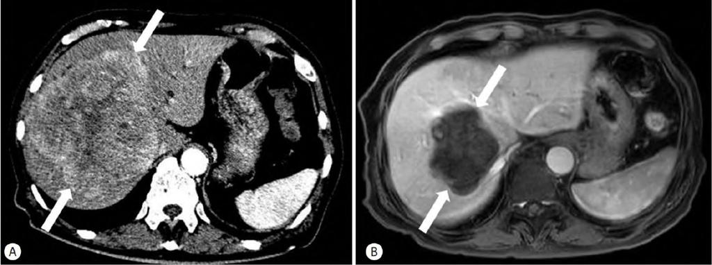 Radioembolization for the treatment of hepatocellular carcinoma: example of efficacy CT scan shows 13cm sized well-demarcated hypervascular
