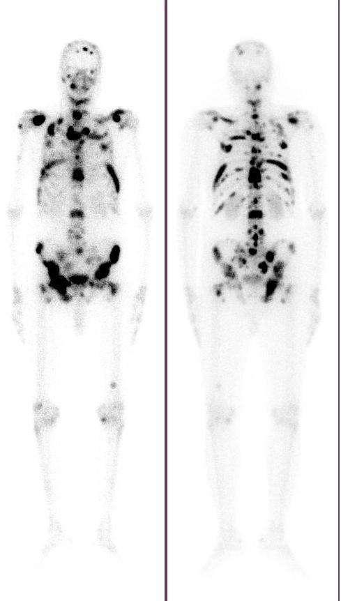 Tc-99m MDP Bone Scan and Post Therapy 177 Lu-EDTMP Scan Tc-99m MDP Bone Scan (Left panel) and Post Therapy 177 Lu-EDTMP Scan (right panel) of a 69 yr old male,