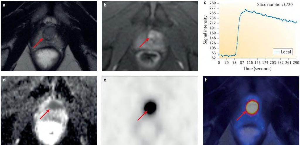 PSMA/MR guided Prostatic Biopsy 68 Ga-PSMA PET MRI of a 50-year-old patient who had a rising serum PSA value (16 ng/ml at imaging) and two tumour-negative previous biopsy samples T2-weighted image
