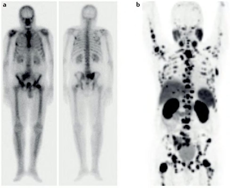 Imaging of 65-year-old patient with prostate cancer and diffuse bone metastases Imaging of 65-year-old patient with prostate cancer and diffuse bone metastases.