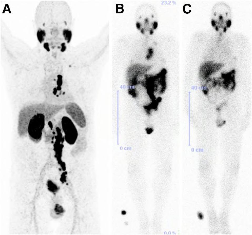 70-y-old patient with PSMA-avid lymph node metastases on 68Ga-PSMA PET/CT before therapy (A) and on 177Lu-PSMA scintigraphy after