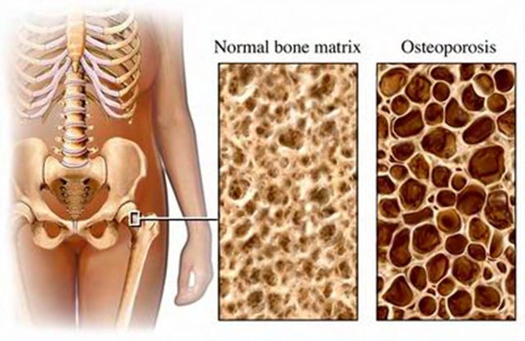 OSTEOPOROSIS Condition characterized by decreased bone strength Defined as: - a