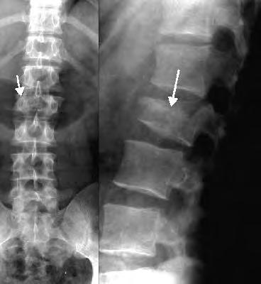 Complications Fractures occur with minimal trauma or spontaneously Vertebral compression fractures: lead to kyphosis; can cause neurological