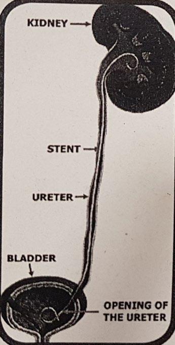 bladder. The stent may be inserted as an additional part of an operation on the ureter and kidney (e.g. ureteroscopy).