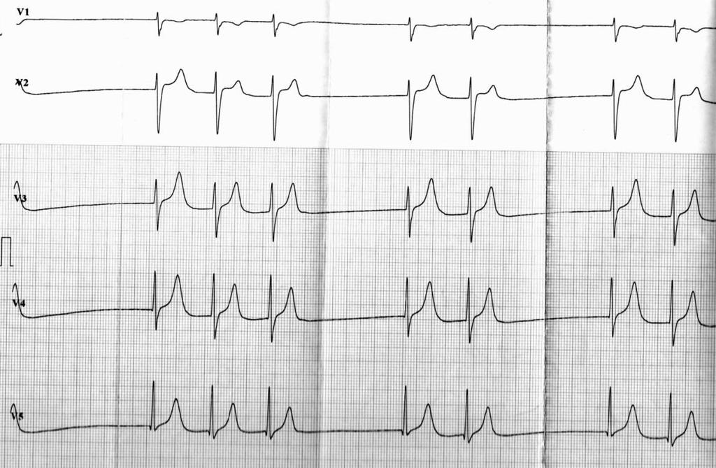 Case report We present the case of a 33-year old male patient with no relevant personal medical history but with family history significant for sudden cardiac death (a brother at the age of 20).