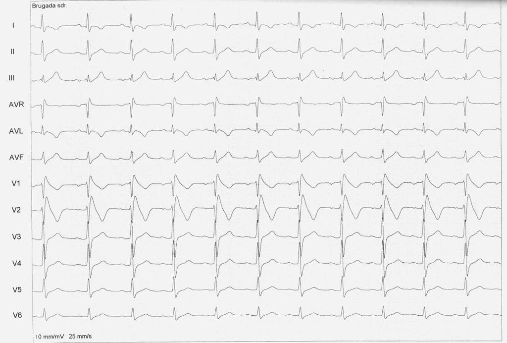 Fig. 2. 12 lead ECG performed before the flecainide test Fig. 3.