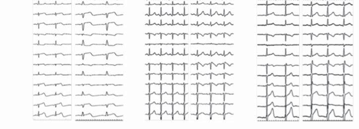 Tabella I - Patients with Left Ventricular Non-Compaction (LVNC) and Brugada Syndrome (BrS) share SCN5A mutation.