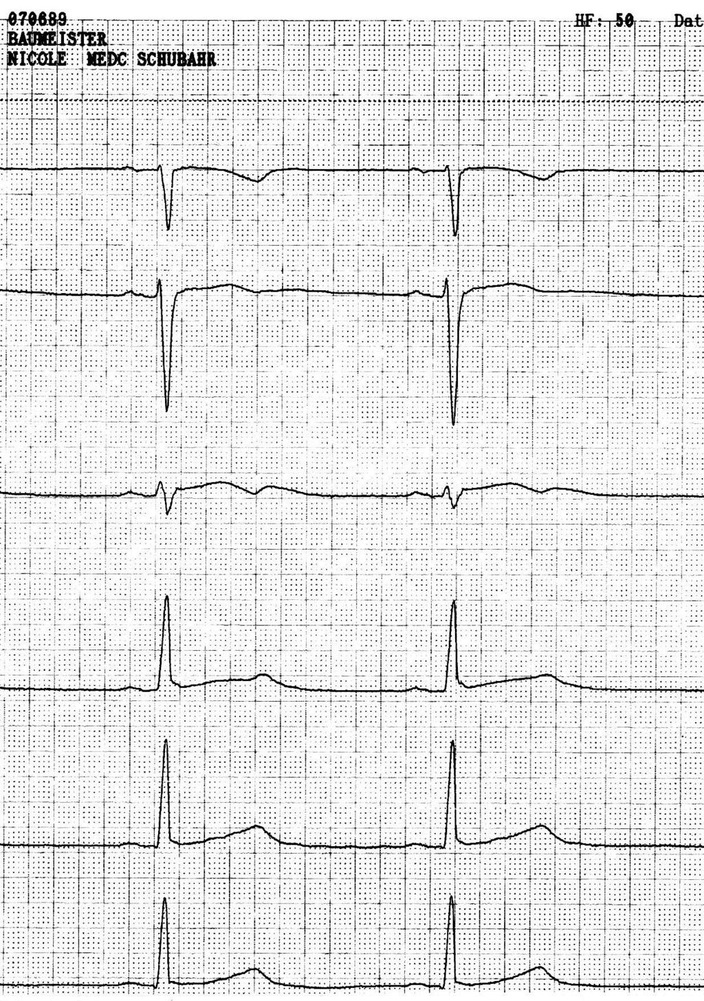 629 ms QTc: 547 ms ECG of the proband s sister, 16-y