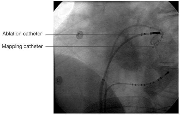 Catheter ablation