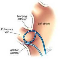 Catheter ablation -
