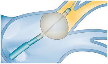 Catheter ablation New