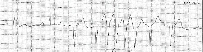 Ventricular arrhythmia VES Non sustained VT VT / VF and sudden cardiac death Dilated