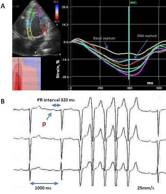 Study 1 Risk prediction of ventricular arrhythmias and myocardial function in Lamin A/C mutation positive subjects Nina E.