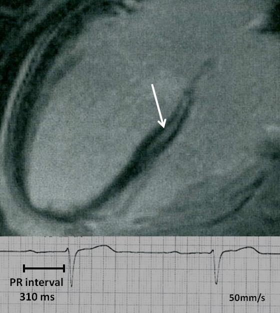 CMR(n=12) Myocardial fibrosis was found exclusively in the interventricular septum and only in patients with VT. PR interval was prologned in patients with fibrosis in the septum.