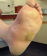 Etiology - Neuropathy JOINT ARTHROPATHY Sturctural foot abnormalities Charcot foot Painless, progressive and degenerative