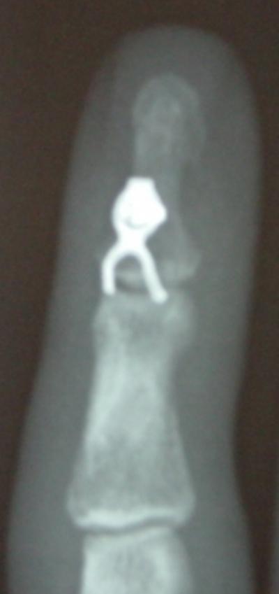 Should the treatment fail it can be used later for a Y to V DIPJ tenodesis or a DIPJ arthrodesis to