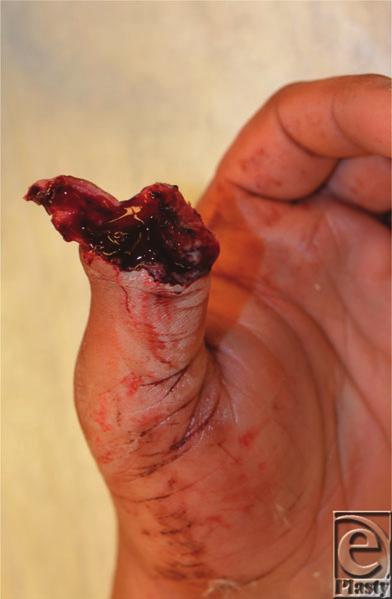 Interesting Case Series Traumatic Thumb Amputation: Case and Review Ryan Engdahl, MD, a and Norman Morrison, MD b a Division of Plastic Surgery, New York Presbyterian Hospital, The University