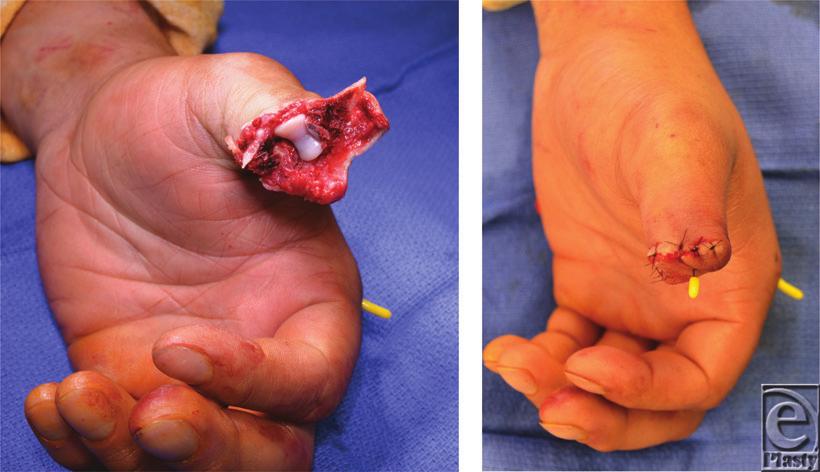 Figure 3. (a, b) Intraoperative debridement of the distal thumb avulsion injury.