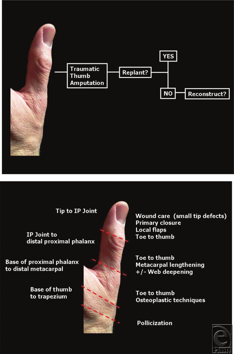 Figure 4. A simplified algorithm for a traumatic thumb amputation.