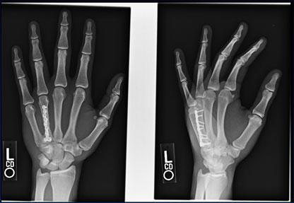 Plate and Screws: RTP 4 weeks Non-Operative vs Operative Treatment Pros Cons