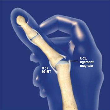 ) Risk of re-fracture Operative Treatment Can start ROM immediately Bone is fixed and