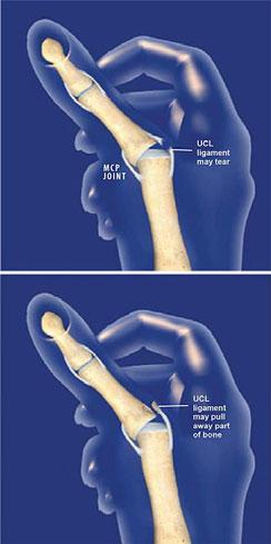 Thumb UCL Tears When do we operate acutely?
