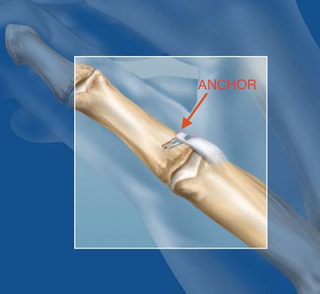 non-displaced, can consider playing with splint Thumb UCL Tear: Traditional Surgery Suture Anchor Repair of ligament back to bone Thumb Cast for 4-6 weeks, then