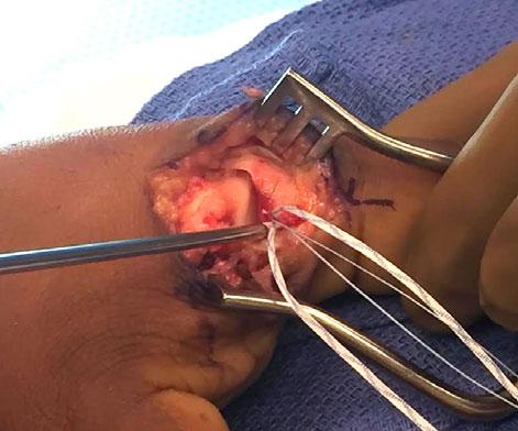 ankle ligament reconstruction, now for other indications, e.g. Achilles, ACL, MCL, elbow UCL, etc.