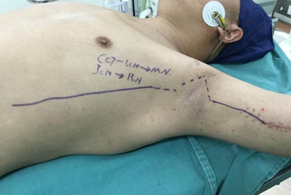 Figure 1. The incision for inter coastal nerve transfer to the medial portion of radial nerve.