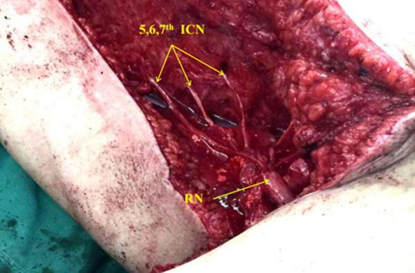 Based on the previous anatomic study of yang, we selectively transfer intercostal nerve to radial nerve in the axilla. The surgical procedure and outcome are presented here.