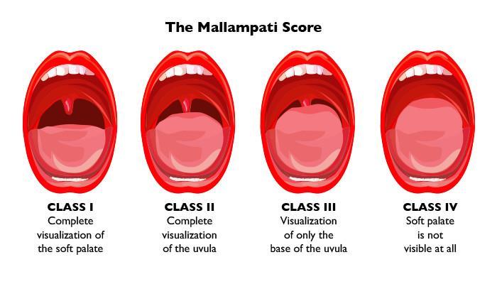 Examination A Any intubation concerns (including dentures) Review mouth opening (Mallampati classification) B