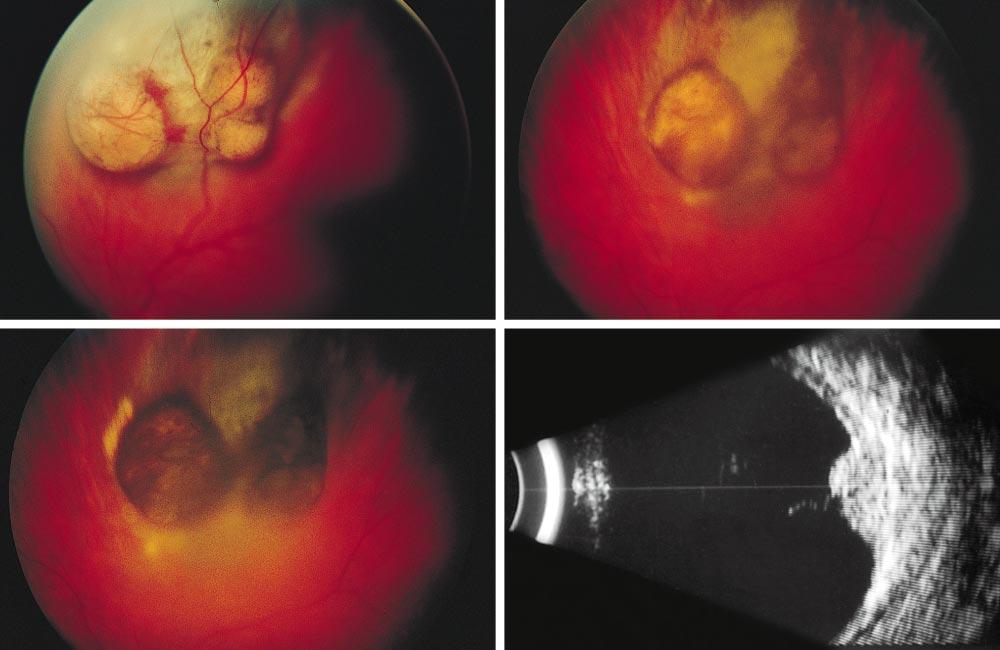 D Figure 2. ase 2., Three collar-button excrescences on a choroidal tumor before brachytherapy., Four years after brachytherapy, 2 of the collar-button lesions have assumed the dark chocolate color.