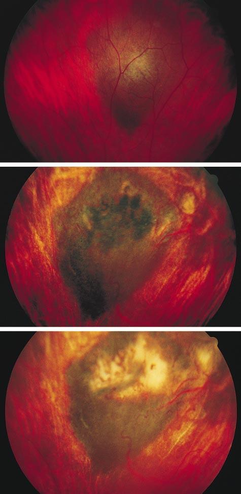 Figure 4. ase 4., horoidal tumor with collar-button formation in a 42-year-old woman before brachytherapy (3.5 mm thickness).