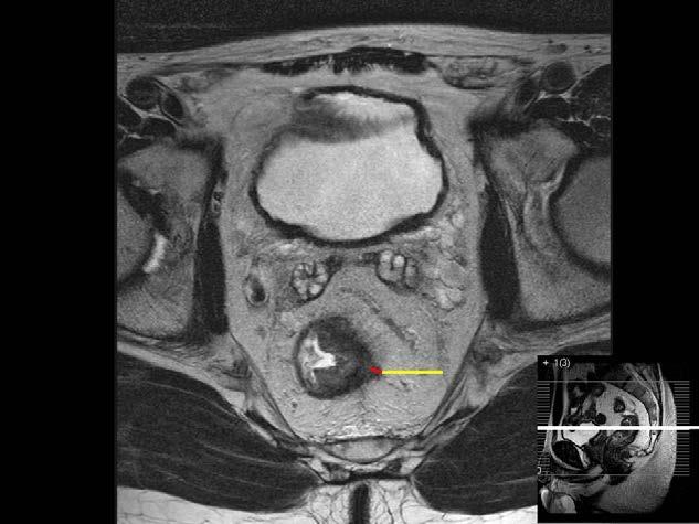 Figure 1. Magnetic resonance images (MRI) of the pelvis. Transaxial T2-weighed MR-image showing a semi-annular tumour in the mid rectum.