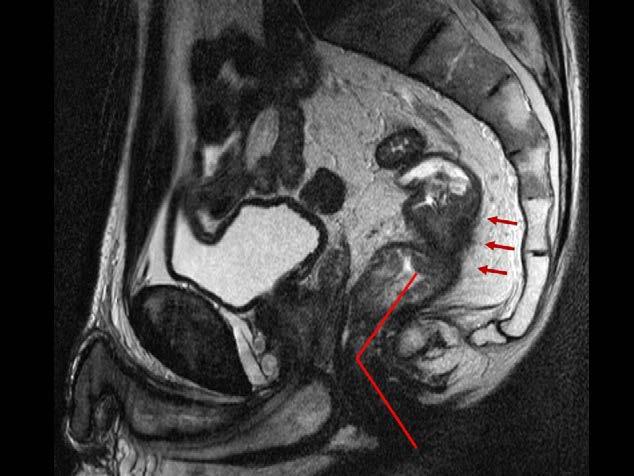 The yellow line indicate how the closest distance from extramural tumour to the mesorectal fascia is measured (white thick line on the sagittal small image in the right lower
