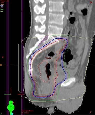 6 cm from the anal verge Inner red lines: tumour borders. Orange lines: clinical target volume.