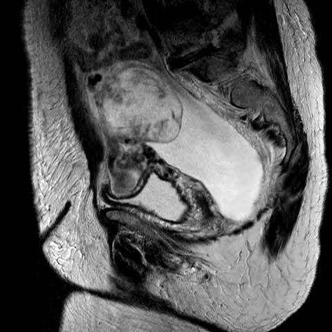 MRI images Right ovary Sacrum Right