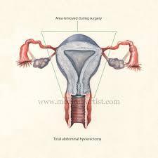 Struma ovarii is a rare ovarian neoplasm