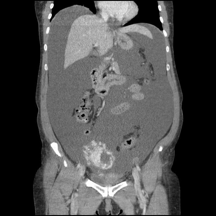 CT Images Liver Liver