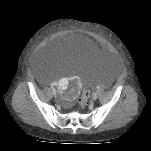 Right ovary Coronal image