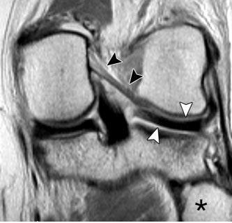 Background: Lateral Meniscal Root Tears Combined injury with up to 12% of ACL tears Function of